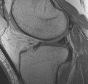 Meniscus MRI Increased Signal